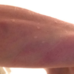 Jill's bruised forearm, fingerprints clearly visible. Click to enlarge.