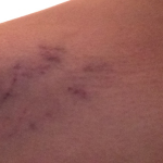 Jill's bruised inner thigh, which turned into a DVT. Click to enlarge.