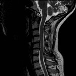 MRI of my neck from July 2012. Click to enlarge.