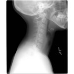 X-ray of my neck July 2012. Click to enlarge.
