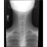 X-ray of my neck July 2012. Click to enlarge.