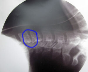 X-rays during surgery, lying on my back. It's easy to see the problem.