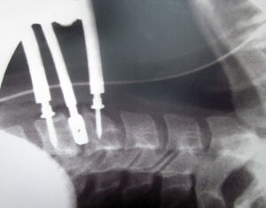 Screws inserted in my bone, the disc is removed.